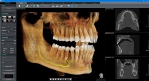 X-ray of teeth