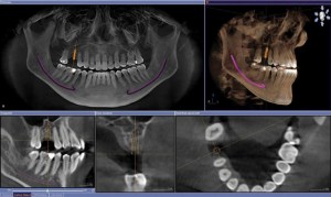 X-ray of teeth