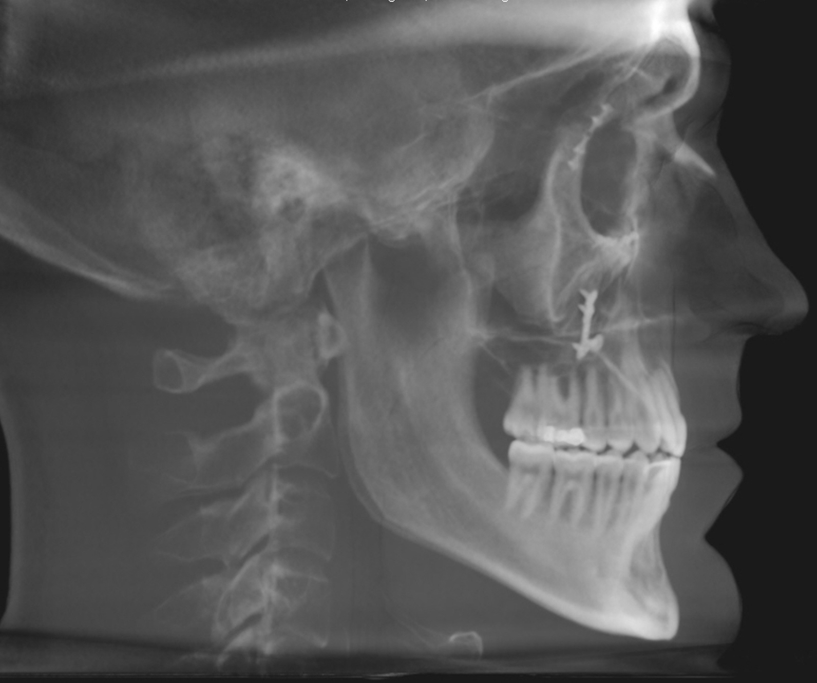 Xray of Mouth