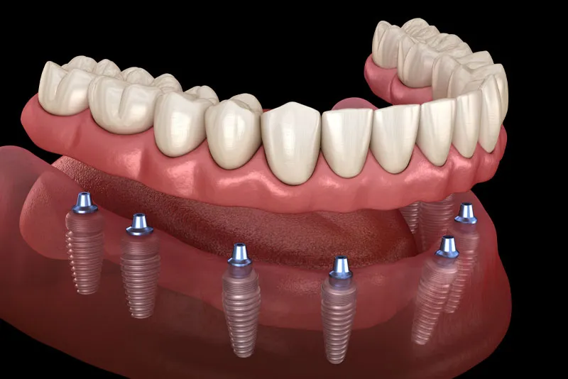 Dental Implants