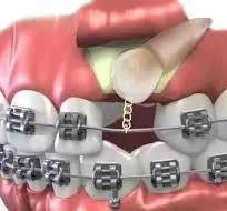 Impacted teeth Expose and Bond