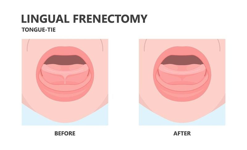 lingual frenectomy