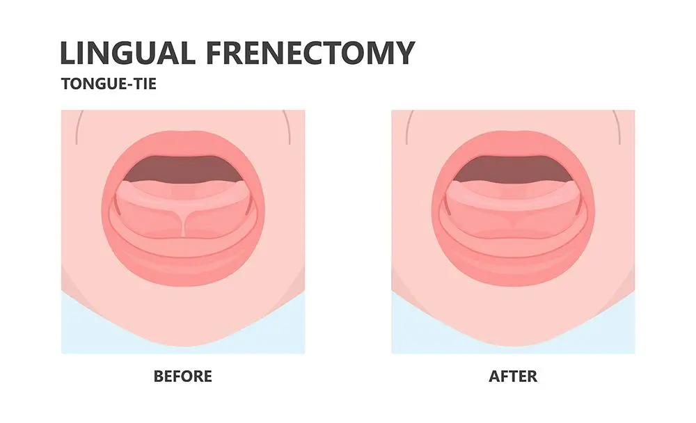 lingual frenectomy