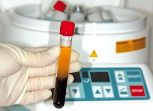 Platelet-Rich Fibrin	