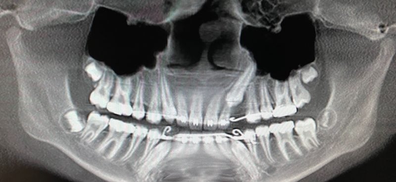 Xray of teeth