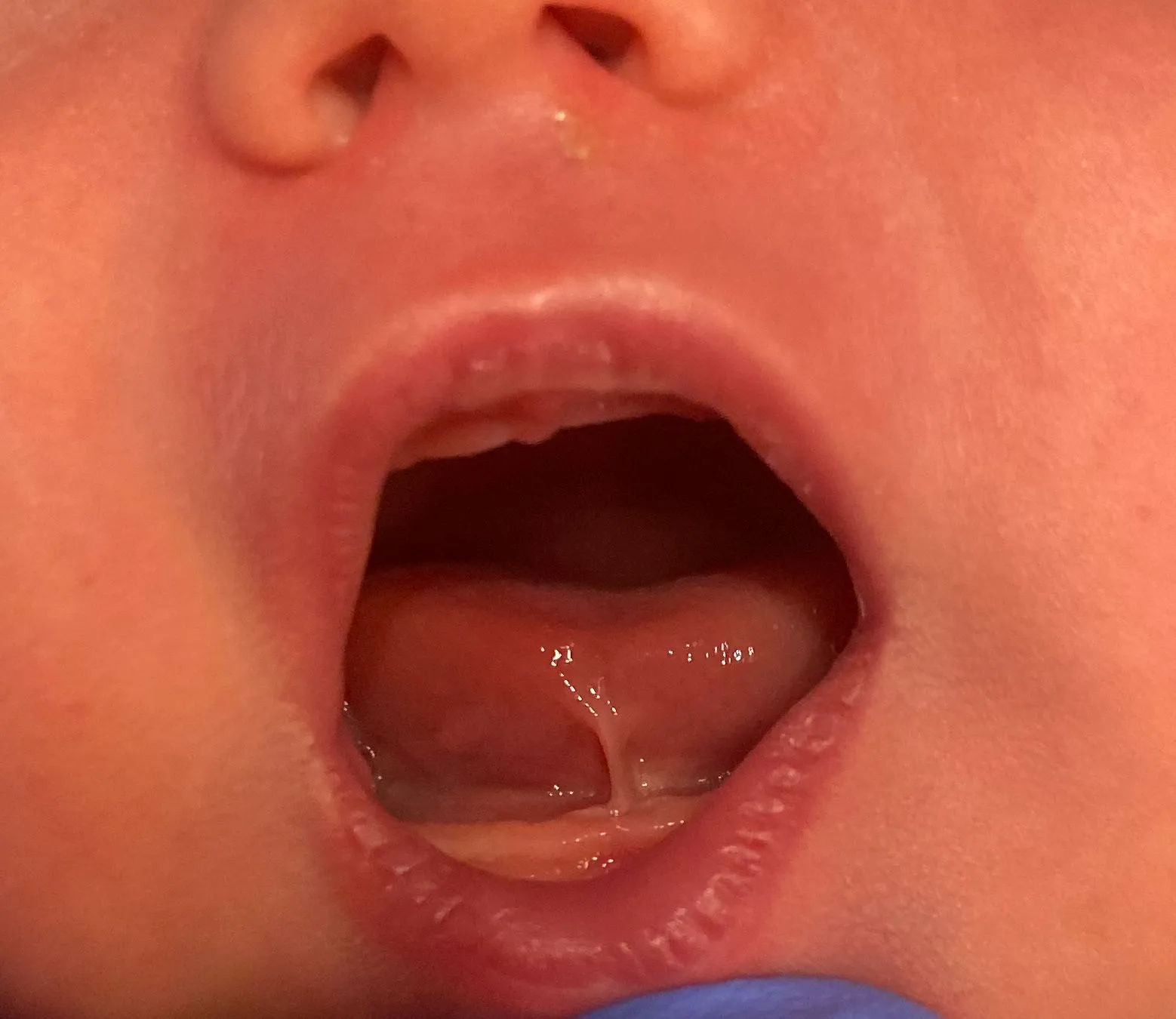 Frenectomy/Tongue Tie